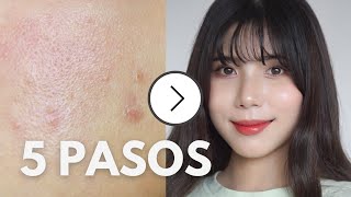 CÓMO ELIMINAR EL ACNÉ EN 5 PASOS I Tips del Skincare Coreano✨ [upl. by Kieran]