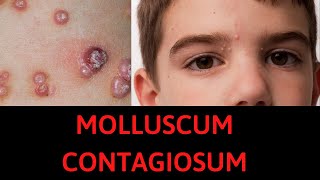 What is Molluscum Contagiosum Symptoms Treatment [upl. by Brine174]