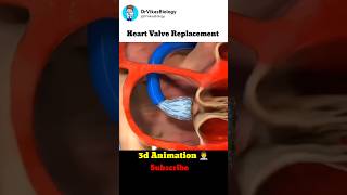 Heart Valve Replacement Procedure 👨‍⚕️ [upl. by Latona502]