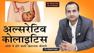 Ulcerative Colitis  अल्सरेटिव कोलाइटिसआंतो की गंभीर बीमारी  Dr Mahesh Gupta [upl. by Abebi729]