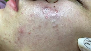 Acne treatment for Spa Linh Mun 2023 027 [upl. by Arelus]