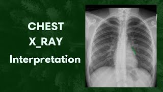 What is this called Chest X ray Interpretation 🤔anatomy youtube radiology [upl. by Akem31]