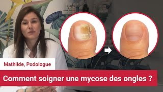 Soigner et reconnaitre la mycose des ongles des pieds  Conseil dune podologue [upl. by Stevy]