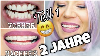 2 JAHRE FESTE ZAHNSPANGE  UPDATE😮 QampA Zahnspange Erwachsene Keramik Brackets WithKat [upl. by Ziguard]