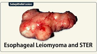 Esophageal Leiomyoma and STER [upl. by Nolyak]