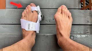 I Tried a Bunion Corrector Heres What Happened [upl. by Ama]