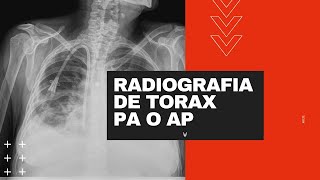 Radiografía de tórax PA o AP Cual es la proyección que estas viendo [upl. by Eisnyl]