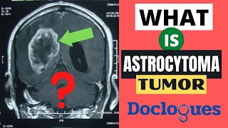 What is Astrocytoma Tumor [upl. by Yahiya]