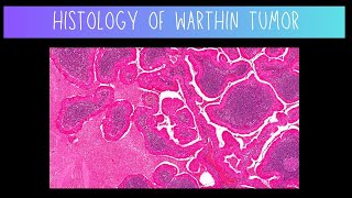 Histology of Warthin Tumor  Dentistry [upl. by Imas717]