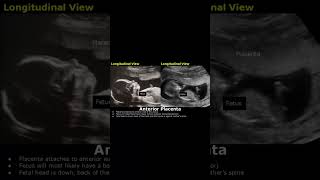 Anterior Placenta Position Ultrasound  Fetal USG  Pregnancy Sonography  Dr Sams Imaging shorts [upl. by Walliw419]