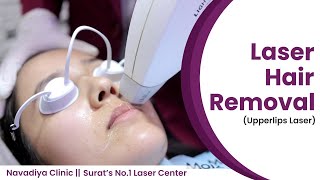 Laser Hair Removal  Upper Lips  Lumenis Lightsheer [upl. by Rob233]