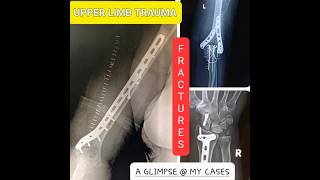 Upper Limb Fractures A Glimpse  My Cases [upl. by Hussar]