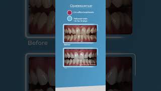 Opalescence™ Boost™ and Opalescence™ PF  Case Study [upl. by Pepe]