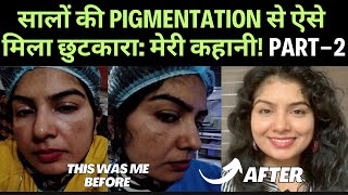 झाइयों से छुटकारा मेरी स्किन का असली सफर  HOW I CURED MY MELASMA PART 2  pigmentation [upl. by Onej]