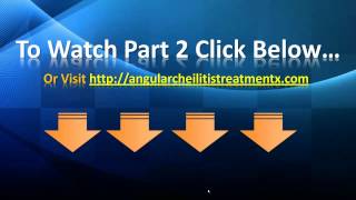 Angular Cheilitis Treatment  Angular Cheilitis Home Remedies [upl. by Eadas]