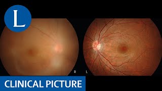 HTLV1 uveitis and Graves’ disease [upl. by Tirrag]