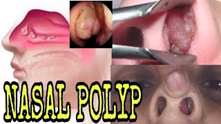 homoeopathic treatment for nasal polyp [upl. by Anihs]