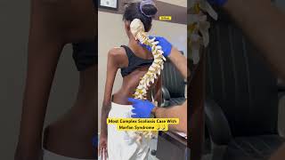 Most complex scoliosis case with Marfan syndrome treatment by DrRavi scoliosis chiropractor chiro [upl. by Croydon733]