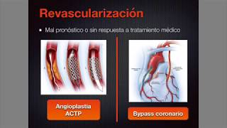 Cardiopatía isquémica 1 ¡Todo lo que debes saber [upl. by Carberry225]