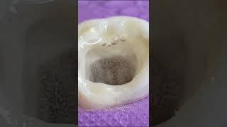 TOOTH CAVITY restoration rootcanal shorts [upl. by Damalis921]