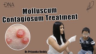 How to treat Molluscum Contagiosum  Treatment of viral skin infection  Dr Priyanka Reddy [upl. by Mylo]