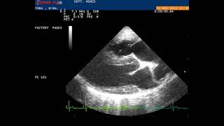 Echocardiography right parasternal longaxis view showing [upl. by Ob]