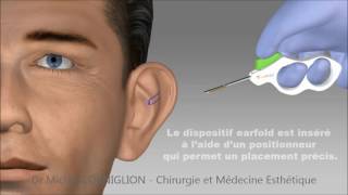 Earfold  une technique non chirurgicale pour les oreilles décollées  Dr Corniglion [upl. by Robb]