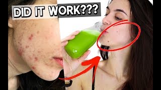 I drank CELERY JUICE for 7 DAYS to CLEAR my ACNE This is what happened [upl. by Naesyar735]