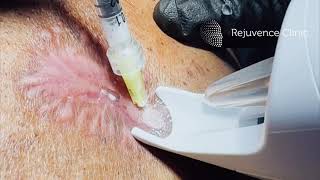 Intralesional steroid injections for keloid scars on the body [upl. by Madaras]