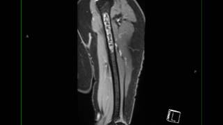 Conventional Chondrosarcoma Humerus [upl. by Kcirrag]