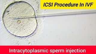 ICSI Procedure in IVF  Intracytoplasmic sperm injection  Assisted Reproductive Technology ICSI [upl. by Kcirdahs]