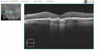 OCT Tutorial Geographic Atrophy in Dry AMD [upl. by Grethel125]