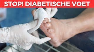 5 Symptomen Van Een Diabetische Voet  Tips Voor Een Behandeling [upl. by Otrebogir450]