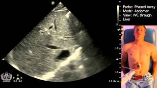 IVC Ultrasound STEP by STEP  Easiest Method [upl. by Artenak]