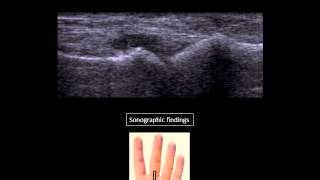 Metacarpophalangeal joint effusion at US [upl. by Annavas572]