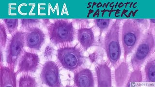 EczemaAtopic Contact Dermatitis etc Spongiotic Dermatitis Pattern  Inflammatory Dermpath Basics [upl. by Eidualc]