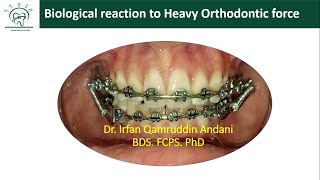 Biological Response of PDL to Heavy Orthodontic force [upl. by Driskill670]