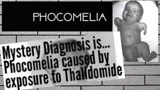 Phocomelia and teratogenicityeasiest explanation [upl. by Jobye]