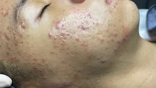 ACNE TREATMENT VU QUYNH MI  Perennial Blackheads On Boy Face 2024FULL [upl. by Rangel]