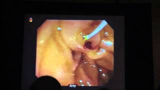 Peter Cottons Last ERCP  the Procedure [upl. by Ruhtracam]