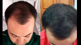 Shampoo folicure no funciona  Regenerador capilar rc  caida de cabello [upl. by Neelrahc754]