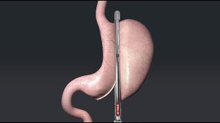 Animation of Sleeve Gastrectomy with Titan SGS™ [upl. by Abehsat]