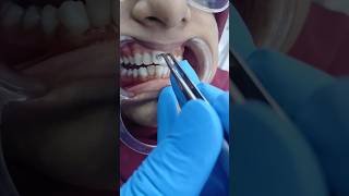 Braces treatment dentist dentalsmiledesigning dentaltreatment smiledentist dentalclinic smile [upl. by Eiramacissej]