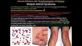 107P Severe Combined Immunodeficiency Wiskott Aldrich Syndrome [upl. by Ydnem]