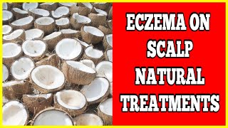 Eczema On Scalp Natural Treatment  Easy And Effective On Scalp Natural Treatment [upl. by Ibbison]