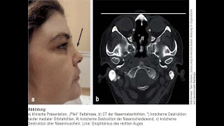 Orbitabodenbeteiligung bei Granulomatose mit Polyangiitis [upl. by Gillett]