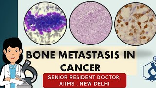 Bone metastasis in cancer Symptoms and diagnosis  A casebased study [upl. by Hinson546]