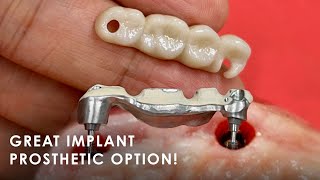 What is Prosthodontics [upl. by Yecnay]