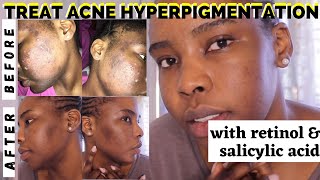 Treat HYPERPIGMENTATION  DARK SPOTS using Retinol amp Salicylic acid  Post AccutaneAcne Scarring [upl. by Folly835]