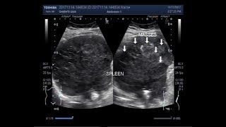 Ultrasound Video showing Hypoechoic splenic lesions [upl. by Neeneg]